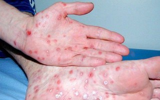 Thông tin nổi bật tại TPHCM ngày 4-5: Người mắc bệnh giang mai tăng; mở rộng đường Trần Bình Trọng