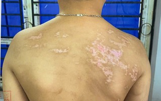 Bé trai 7 tuổi có 21 vết sẹo trên cơ thể do bị cha đẻ bạo hành