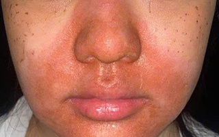 Cô gái trẻ nhập viện với gương mặt đỏ rực, bong tróc sau peel da