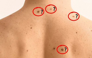 Nổi nhiều nốt ruồi là dấu hiệu ung thư?