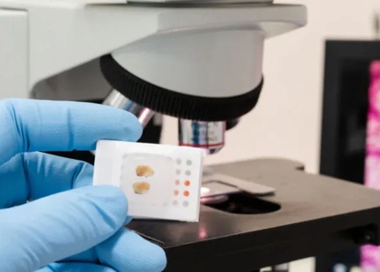 Thêm tiềm năng của AI trong cải thiện điều trị ung thư