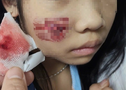 Khỉ hoang tấn công, bé gái 7 tuổi nhập viện