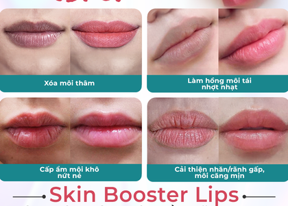 Top 3 nơi "trẻ hóa môi" uy tín tại TPHCM