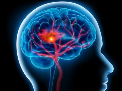 Tại sao nhiều người sau đột quỵ bỗng nói tiếng nước ngoài?