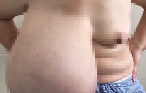 Người phụ nữ mang “núi đôi” chênh nhau gần 9 kg