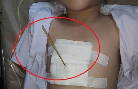 Bé 7 tuổi bị bạn dùng cây xiên cá viên chiên đâm trúng ngực