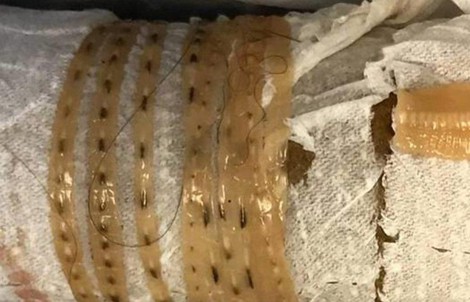Mỹ: Ăn sushi hàng ngày, kéo ra giun dài hơn 1,6 m