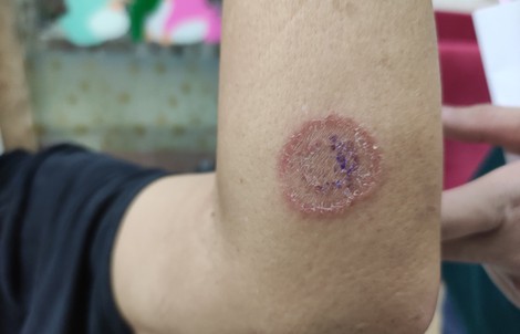 TP HCM: Ngủ chung với thú cưng, nổi đóa đầy người