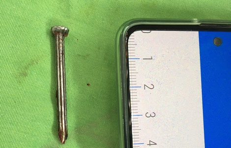 Bị trầm cảm 12 năm, cụ ông tự lấy đinh đóng vào đầu