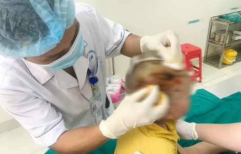 Bé 3 tuổi bị chó hàng xóm cắn trọng thương vùng đầu, mặt