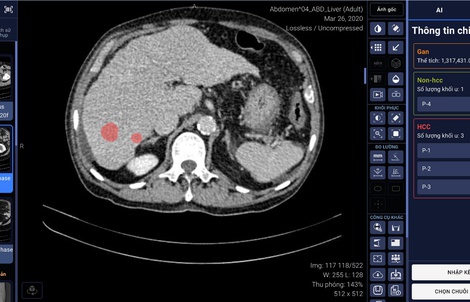 VinBrain cùng Bệnh viện ĐH Y dược TP HCM phát hiện và chẩn đoán ung thư gan bằng AI