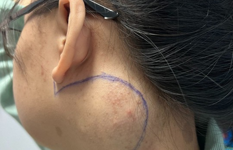 Cắt bỏ khối u ở vị trí nguy hiểm của cô gái 18 tuổi