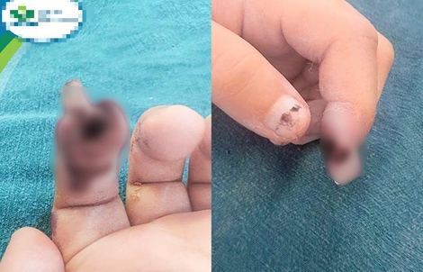 Kẹp tay vào cửa kính thủy lực ở siêu thị, bé 3 tuổi bị đứt ngón tay
