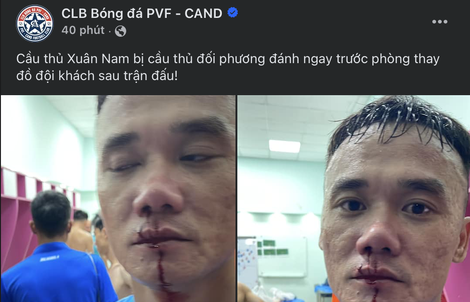 Xuân Nam bị đánh rách môi, hai đội PVF - CAND và Trẻ TP HCM tố nhau