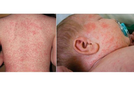 Bệnh sởi, rubella tăng, Bộ Y tế yêu cầu giám sát