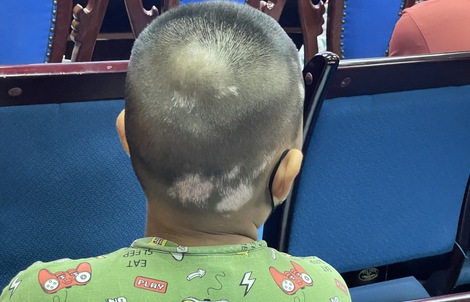 Bệnh bạch biến có chữa khỏi được không?