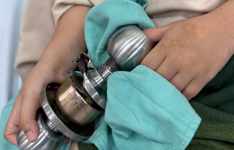 Bé trai vào viện cấp cứu cùng ổ khoa dính chặt ngón tay