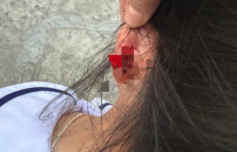 Xác minh vụ cô giáo ở Phú Quốc nhéo tai học sinh lớp 1 đến chảy máu