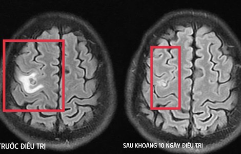 Co giật do sán não suýt nhầm lẫn với u não