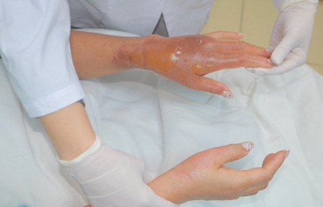 Bồn cầu phát nổ sau khi đổ hóa chất, người phụ nữ bỏng nặng