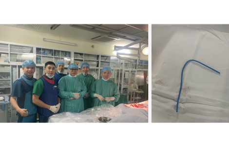 Ống thông truyền hóa chất bị bỏ quên suốt 3 năm, đứt trôi vào tim người phụ nữ