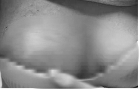 Hoại tử ngực vì tiêm chất làm đầy