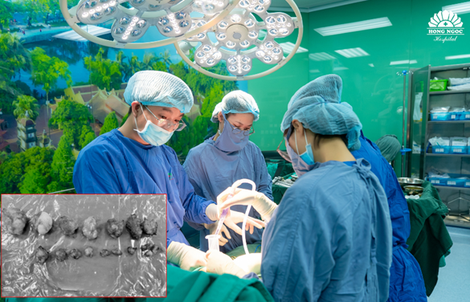 Bóc 18 khối u xơ, bảo toàn tử cung cho bệnh nhân