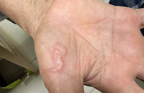 Nhập viện vì chăm thú cưng
