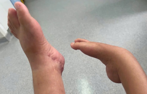 Bé gái đi được bằng chân sau 12 năm di chuyển bằng đầu gối