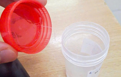 Sinh vật lạ dài gần 10 cm trong mắt người phụ nữ