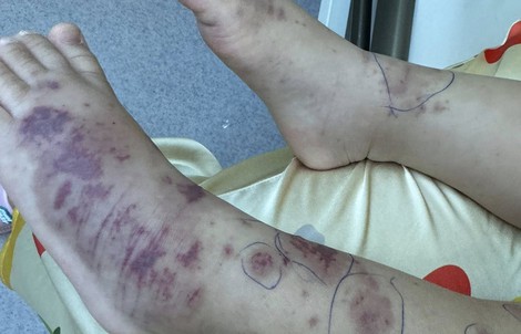 Chuyên gia cảnh báo về một căn bệnh nguy hiểm, lây lan nhanh, tỉ lệ tử vong cao