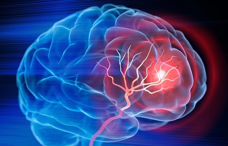 Mỹ phát triển phương pháp trị đột quỵ mới, chỉ cần 1 lần truyền dịch