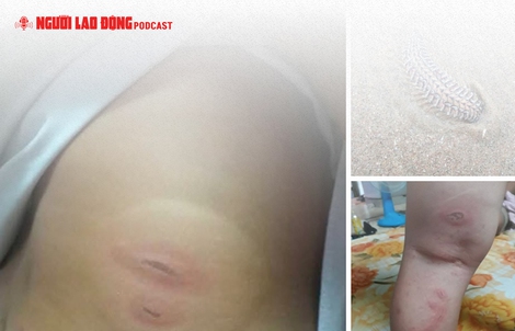 Sự thật vụ việc bé 3 tuổi "bị sâu biển cắn nguy kịch"