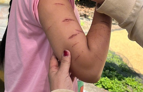 Sở Y tế tỉnh Cà Mau thông tin về vụ nữ sinh bị chị họ gây thương tích