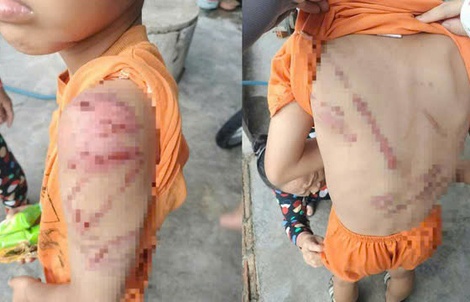 Lý do người cha đánh con 10 tuổi bầm tím khắp người