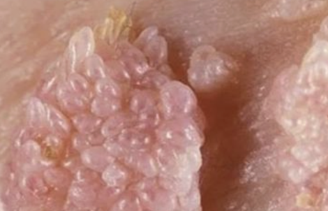 Người đàn ông gần 70 tuổi mắc sùi mào gà sau quan hệ không an toàn