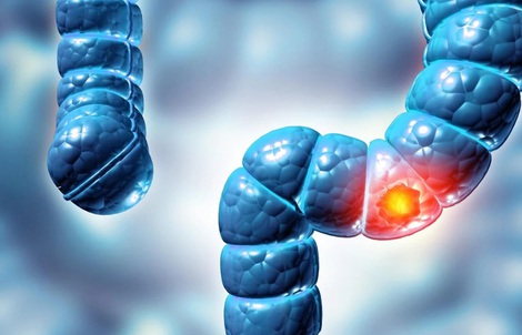 Phát hiện virus mới liên quan loại bệnh ung thư phổ biến