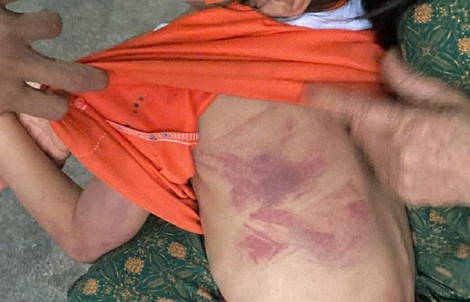 Bé gái lớp 2 bị bạn cùng lớp dùng thước đánh thâm tím người vì không cho kẹo