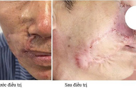 Ung thư da tái phát sau nhiều lần mổ, lan ngầm dưới da