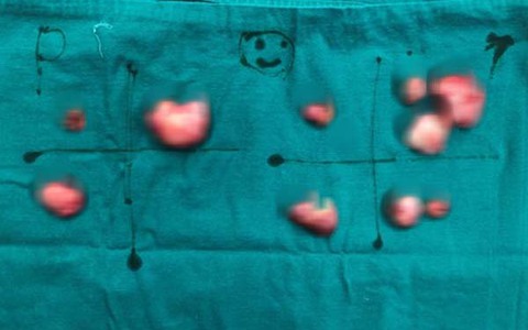 Phẫu thuật "nhặt" 10 khối u lớn, nhỏ ở ngực cho người phụ nữ trẻ