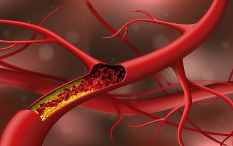 Cholesterol cao: Thêm nguyên nhân bất ngờ, không liên quan ăn uống
