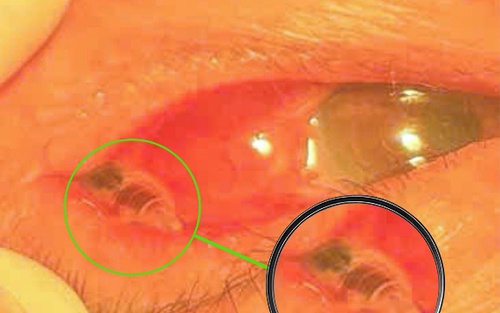 Xử lý kịp thời một bệnh nhân bị ong chui vào mắt