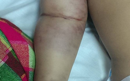 Cứu sống kỳ diệu bé 2 tuổi bị tỷ lệ kèo nhà cái hôm nay độc cắn nhiều ngày