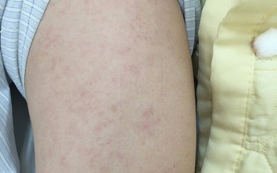 Nữ bệnh nhân 28 tuổi bị biến chứng hiếm gặp sau mắc tỷ lệ cá cược kèo nhà cái