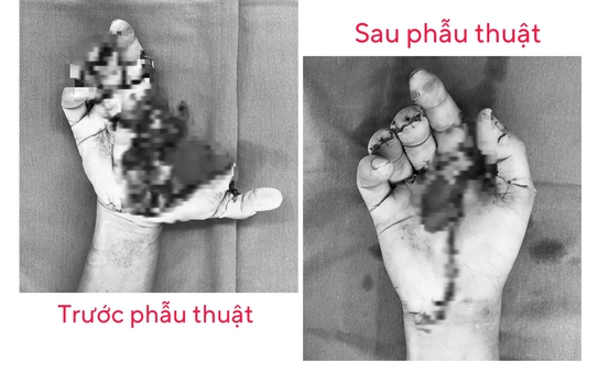 Một bệnh viện tiếp nhận 15 ca tai nạn tỷ lệ cá cược kèo nhà cái pháo nổ trong ngày