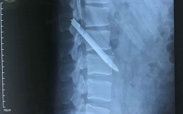 Lưỡi dao dài 13 cm nằm trong cơ thể chiến sĩ công kèo nhà cái tỷ lệ cá cược suốt 11 năm
