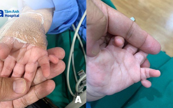 Bé gái sinh ra khác thường với 24 ngón tay, chân
