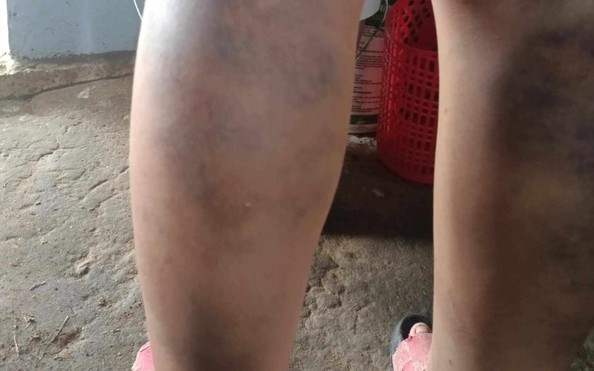 Kỷ luật cô giáo "tỷ lệ cá cược kèo nhà cái động vật lý" khiến học sinh bầm tím 2 chân