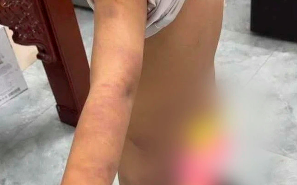 Làm rõ nghi vấn nam sinh lớp 6 bị bạo tỷ lệ kèo nhà cái hôm nay với nhiều vết bầm tím trên cơ thể