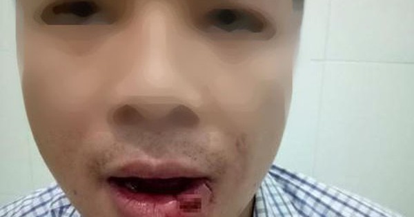 Thầy giáo ném thanh sắt làm hàng xóm là nhân viên tòa án gãy 5 chiếc răng